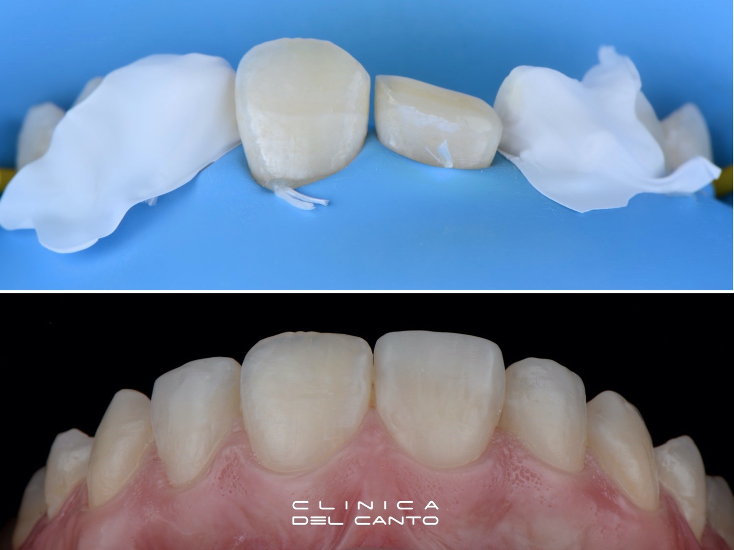 Restauraciones dentales - Clínica del Canto